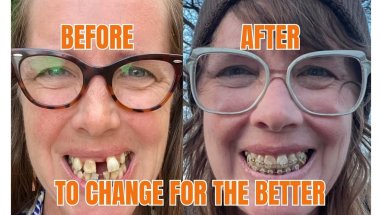 Incredible Transformation! From Crooked Teeth to Perfect Smile | Braces Timelapse
