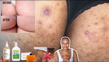 Clear Buttocks Pigmentation & Bumps with These Simple Steps