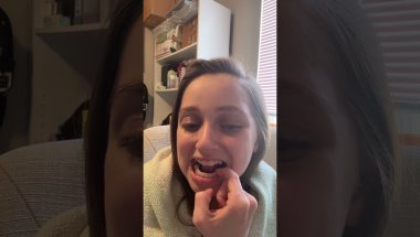 Shauna Rae: Invisalign Day 44