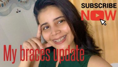My braces update #viral #trending #teeth #braces #teethdecay #vlog #youtuber
