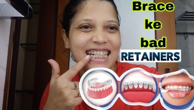 Braces  के बाद retainer ?