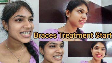 Braces Treatment Start 😲😁