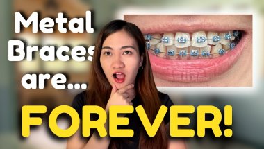 Why Traditional Metal Braces Remain a TOP Choice for Orthodontic Treatment