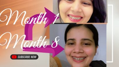 Braces update #viral #trending #shorts #dentalprosthesis #dentaltreatment #teethdecay #braces #teeth