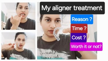 My aligner journey 😬| Aligner treatment in india 🇮🇳 | Smile transformation with aligners 😁 #indore