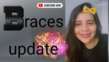 Braces update #viral #trending #dentalprosthesis #teeth #foreigntraineddentist #youtuber #youtube