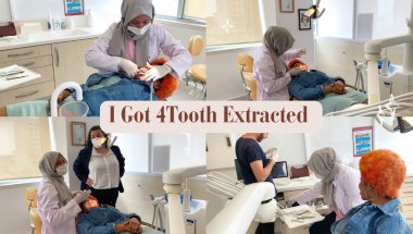 4 TEETH 🦷 EXTRACTED!! FOR BRACES | Healing ❤️‍🩹 UPDATE