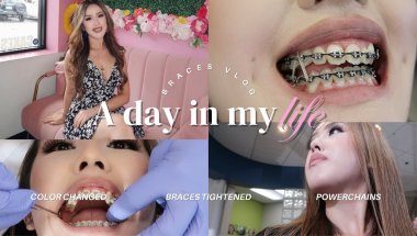 Braces Vlog Ep.12: Come with me to my Ortho visit + new updates!!