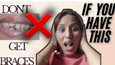 ⚠️ “STOP! Don’t Get Braces put on If.....#braces #mybracesjourney #viral #trending/My braces journey