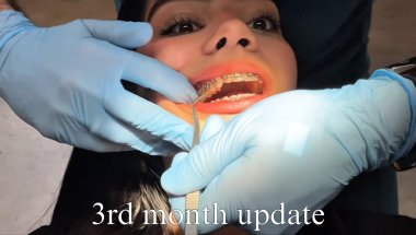 Braces update month 3 🦷 Vlog #3