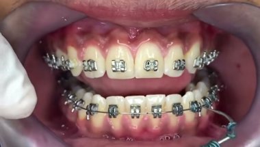 Braces that make your teeth look whiter