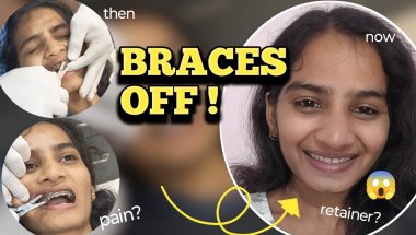 I Finally got my Braces off!  Retainer? Type?
