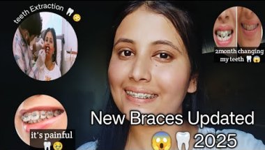 New Braces Updated 2025.🦷😱|| #braces2025 #teethextraction