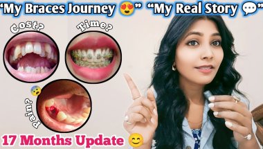 🦷😍 Braces Before And After Video ll Teeth Braces Before And After #braces #bracesjourney #trending