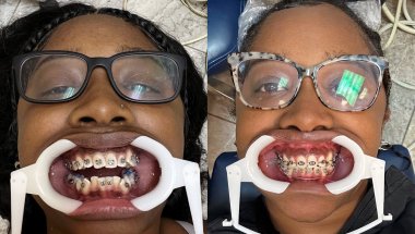 Adult Braces Journey: 2 Year Update! I Swallowed a Bracket + Progress Reveal