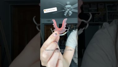 What a retainer looks like after wearing braces