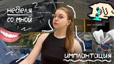 неделя со мной влог | имплантация зубов straumann, моя история, восстановление