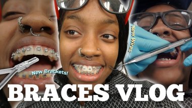 WHATS ITS LIKE GETTING BRACES *COME WITH ME *