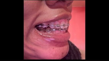 1 1/2 YEARS IN BRACES