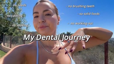 MUST WATCH BEFORE ANY INVISALIGN TREATMENT | GUM SURGERY FULL STORY SMILE DIRECT my story