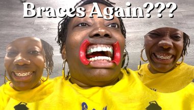 Braces Again??? At Age 35…. 😳
