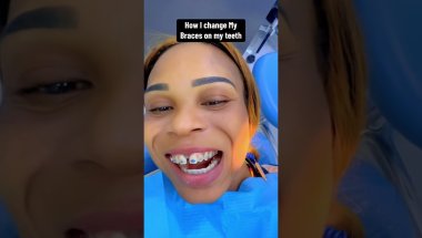 Watch me on how l went to change my braces on my teeth#goviral #highlights #viral #fypp #relateable