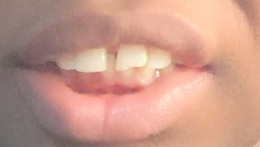 Over bite braces correction.