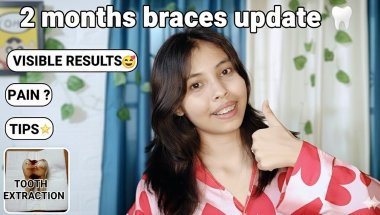 2 Months Braces Update & Tooth Extraction on My Birthday 🎂🦷😭|painful or not?😬🤯||Rifatlife||