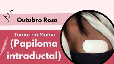 RELATO DE CIRURGIA DE NÓDULO NA MAMA