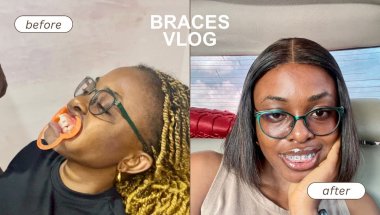 Braces Journey Before and After