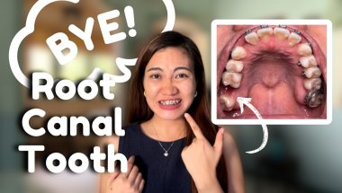 October Braces Update | Tooth Extractions and Root Canal