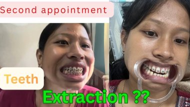 My second appointment for braces||teeth extraction ?