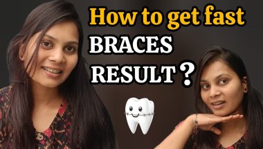 Tips for Quicker Straight TEETH🦷|| How to get your Braces OFF fast?