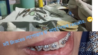 Braces লগোৱাৰ পিছত chack up ত গলে কি কৰি দিয়ে। আৰু কিমান দিন পিছে পিছে  chack up জাব লাগে। 🥰