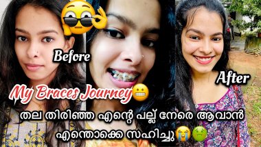 Braces Journey😬ഇത് ഒരു യുദ്ധം തന്നെയാണ്❌എന്തൊക്കെ സഹിക്കണം ദൈവമേ😭#viral #vlog #braces #journey