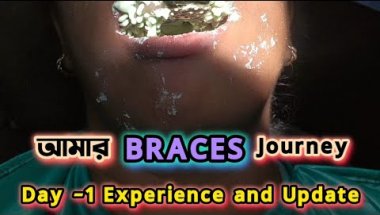 Smile transition journey begins | Braces - Day 1 experience n update