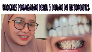 Riview Pemakaian Behel(Braces) di Orthodentis // PROGRES PEMAKAIAN BEHEL 5 BULAN