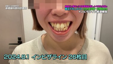 【全部見せます】矯正治療開始から８ヶ月間の変化を全て公開！矯正治療の経過観察｜歯並びの悪さに悩んでいた方の矯正治療ドキュメント第７話｜新橋歯科医科診療所