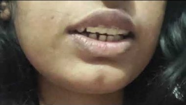 My fifth appointment🙆‍♀️!! My experience🥰#braces #smiledesigndental #dentalbraces #transformation
