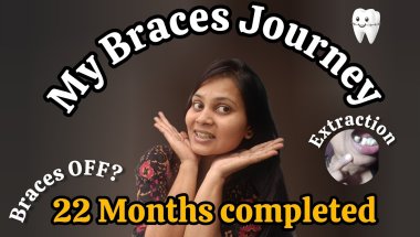 My BRACES JOURNEY 🦷|| Braces OFF ❓😕22 Months completed ‼️