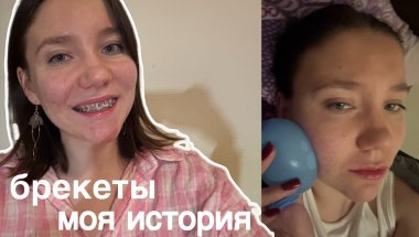 брекеты: установка, стоимость, удаление зубов мудрости