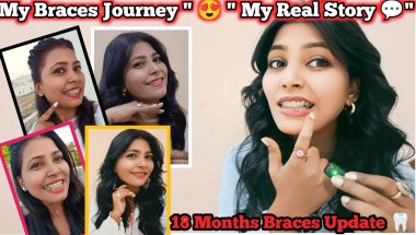 😍 My Braces Journey ll Debunking Braces Myths: Shocking 😨 Truths Revealed 2025  #braces #update