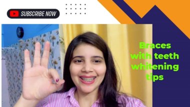 Braces teeth whitening tips#viral #dentist #dentalprosthesis #dentalcare #trending #doctor #dentalbr