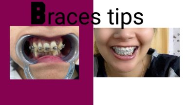 Kya braces lgane ke baad aapka wait km hone lagta gai?#viral #dentist #dentalprosthesis ##trending
