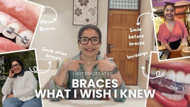 Braces or Invisalign? | What to Expect with Braces? | My Braces Journey as an Adult