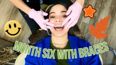 Braces Update 6 🦷 (Completing my sixth month with braces + Braces Cleaning Routine)