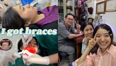 i got braces 😁 sharing all my experiences | ទីបំផុតខ្ញុំបានពត់ធ្មេញហើយ 🦷💕