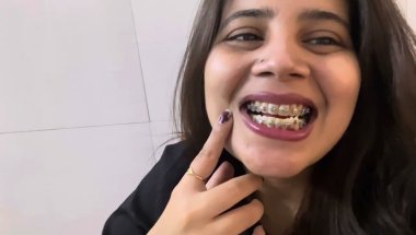 9Months Braces 🦷🥲update#viral #dentist #dentalcare #trending #teeth #dentalprosthesis #trending