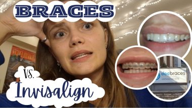 BRACES or INVISALIGN? | come get braces with me | *vlog*