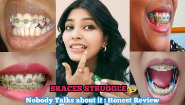 My Braces journey ll  Braces Face Transformation: Myth vs. Reality! ll Real Talk 💬😨 #bracesjourney